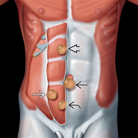 hernia abdominal - dolor abdominal izquierdo